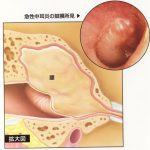 acute_otitis_media