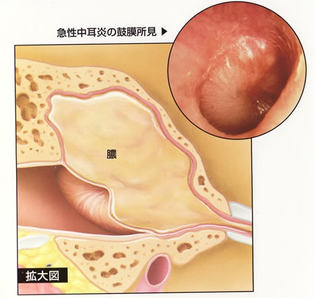 急性中耳炎の鼓膜所見