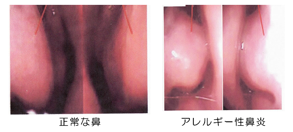正常な鼻とアレルギー性鼻炎