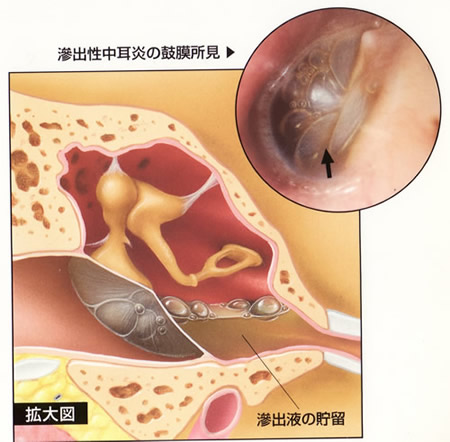 滲出性中耳炎の鼓膜所見