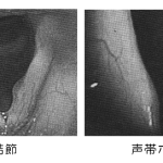 vocal_cord