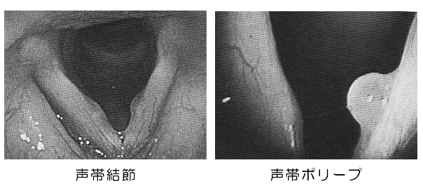 声帯結節、声帯ポリープ